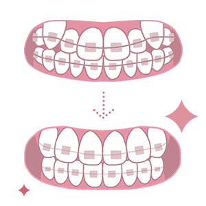 歯列矯正のイメージ