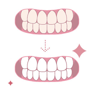 歯のホワイトニングのイメージ